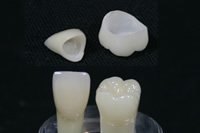 オールセラミッククラウン