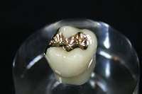 ゴールドインレー