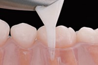 優しい歯石除去