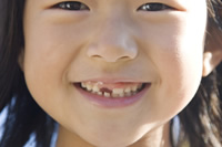 乳歯が抜けた