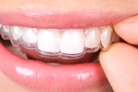 マウスピース型カスタムメイド矯正歯科装置