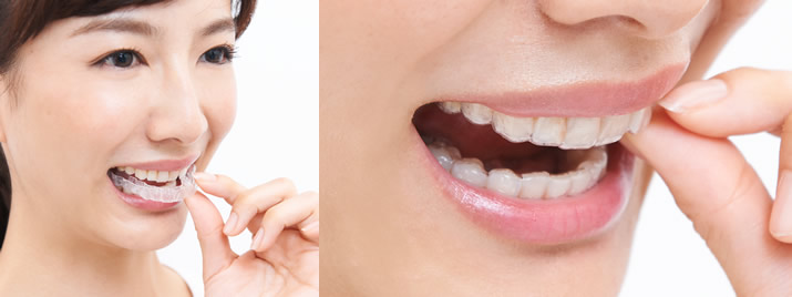 マウスピース矯正