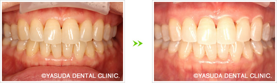ホワイトニング症例